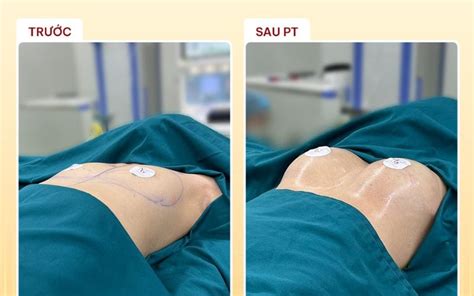 Breast Augmentation: Before and After Photos That Wow